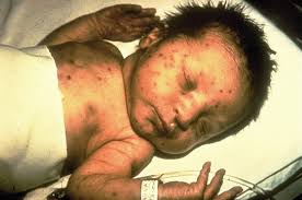 Image result for Rubella