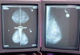 You likely will have another mammogram called a diagnostic mammogram. What Happens After Free Mammogram The Royal Gazette Bermuda News Business Sports Events Amp Community