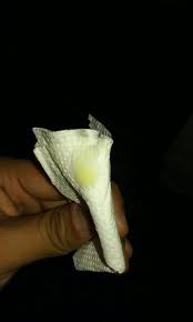 Secrecion Verdosa Amarillenta Sexualidad Ccm Salud