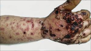 Sometimes eschar becomes very tight and constricting in a burned area. A Case Of Febrile Ulceronecrotic Mucha Habermann Disease With Comorbidities Indian Journal Of Dermatology Venereology And Leprology