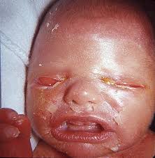 Whereas the primary type most commonly has a genetic cause, secondary myocardial diseases are mostly acquired but may be precipitated by a genetic background. Harlequin Ichthyosis