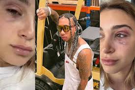 Black-eyed Camaryn Swanson accuses Tyga of physical abuse [photo]