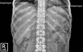 Ribs Radiographic Anatomy Medical Radiography Radiology Schools Advanced Nursing