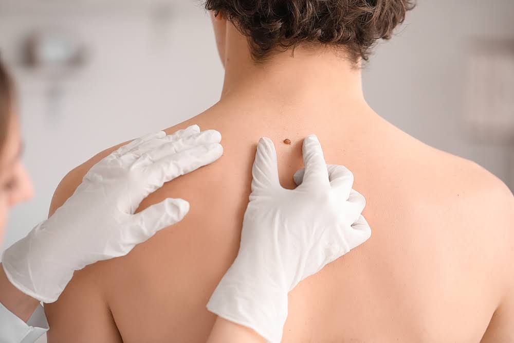 Mole Removal product image