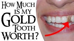 Dental costs cost of a gold dental crown. How Much Is My Gold Tooth Worth Youtube