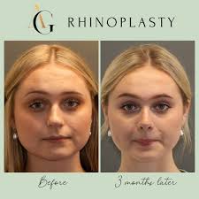 Dr Griffin is a specialist ENT, Head & Neck Surgeon (MED0001664079) with  substantial experience in Facial Plastic Surgery consulting in Brisbane,  Australia. For appointments or enquiries click link in bio. ….