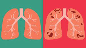 It took nearly 50 years for new tb drugs to be. What Is Tuberculosis Symptoms Causes Diagnosis Treatment And Prevention Everyday Health