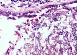 Invasive aspergillosis (ia) is a major cause of morbidity and mortality in children with hematological malignancies and those undergoing hematopoietic stem cell transplantation. Pathology Outlines Aspergillus
