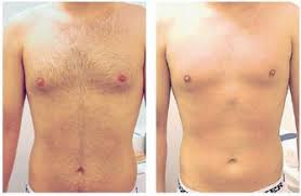 In waxing, the hair is pulled put at the root. Men Hair Removal Tips Waxing And Laser