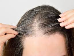 Image result for Alopecia