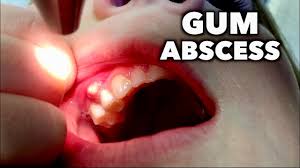 When bacteria gets into the root of a tooth, it can cause an infection. Gum Abscess Tooth Abscess And Gum Abscess