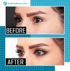 Take a look at our packages. Canthoplasty In Iran Top Eyelid Surgeons Ariamedtour