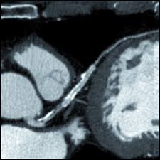 Ct Coronary Calcium Scoring Predicts Long Term Cardiac