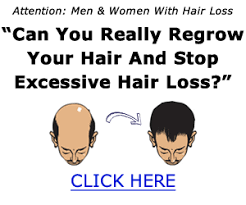 (i have been asked by some of my friends that if i had hair transplant or something, even some strangers. Androgenetic Alopecia Male Pattern Baldness