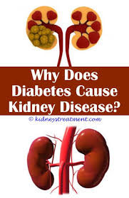 Life expectancy after kidney removal. Polycystic Kidney Disease Mnemonic Kidney Disease Kidney Disease Diet Polycystic Kidney Disease