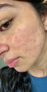 Accutite Vorher Nachher