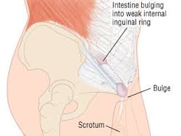 Normally, the abdomen and groin are kept separate by a wall of muscle and tissue. Inguinal Hernia Guide Causes Symptoms And Treatment Options