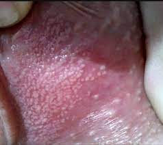 Achtung eklig schamlippe gesundheit und medizin gesundheit. Weiss Jemand Was Diese Punkte Bedeuten Gesundheit Und Medizin Gesundheit Gynakologie