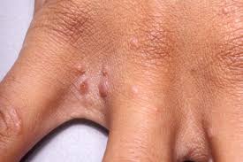 Image result for scabies symptoms