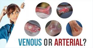 venous vs arterial ulcers whats the difference wcei