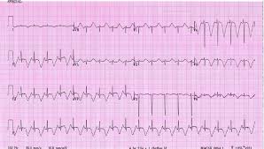 Credit valuation adjustment, cva, is a change to the market value of derivative instruments to account for counterparty credit risk. Neurogenic T Waves Preceding Acute Ischemic Stroke Circulation