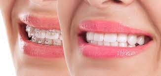 Generally, teeth whitening toothpaste or mouthwash is safe for anyone with braces to use, regardless of the type of braces you have. How To Get White Teeth With Braces 5 Ways To Keep Your Teeth Whiter