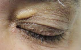 Image result for xantelasma