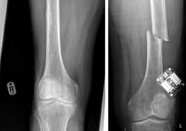 Sources of vitamin d and calcium in the diets of preschool children in the uk and the theoretical effect of food fortification. Confusion Over Vitamin D And Calcium Supplements Study Gm
