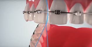 At first, learning to floss with braces takes some practice. How To Floss With Braces Premier Orthodontics