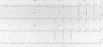 Brugada Syndrome Litfl Ecg Library Diagnosis