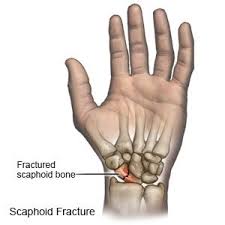 Image result for Scaphoid Bone