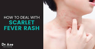 Scarlet Fever Rash Relief 10 Soothing Natural Treatments Health Food Is Medicine Fever Rash Scarlet Fever Rash Rashes