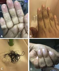 Image result for Beau lines feet