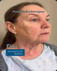 Woman, 66, Lost 110 Pounds and Got a Dramatic Facelift So Shocking, the  Internet Thought It Was Fake (Exclusive)