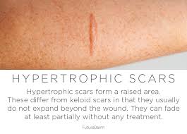 A hypertrophic scar looks similar to a keloid. Month 2 Of The Derma E Scar Gel Challenge Futurederm