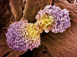 What kinds of tumours do you какие виды опухолей вы знаете? How Breast Cancer Spreads And Recurs