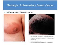 It was just the small, almost invisible dimple that caught her attention, and in. Disorders Of The Breast Ppt Video Online Download