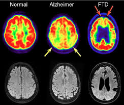 In lbd, protein deposits build up in the brain. The Radiology Assistant Dementia Role Of Mri