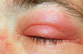 Image result for Erysipeloid