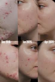 Vitamin c supplement skin reddit. 20 Most Incredible Before And After Photos Of Redditors And The Routines That Transformed Their Skin Daily Vanity