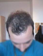 Finasteride is still the most useful medication for preventing and reversing hair loss in the crown area. Massive Hair Loss After Stopping Minoxidil Hair Loss Drugs Hair Restoration Network Community For And By Hair Loss Patients