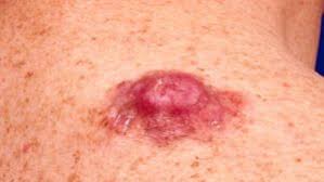 Image result for Dermatofibrosarcoma Protuberans