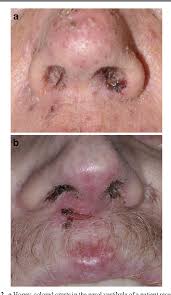 Minor infections at the opening of the nose, called nasal vestibulitis, may result in pimples at the base of nasal hairs (folliculitis) bacitracin ointment or mupirocin ointment usually cures nasal vestibulitis. Figure 2 From Nasal Vestibulitis Due To Targeted Therapies In Cancer Patients Semantic Scholar