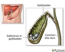 Image result for Gallstone