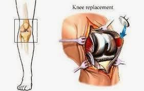 Sakit lutut adalah antara sakit sendi yang sering dialami oleh berbagai peringkat umur. Senaman Untuk Sakit Lutut Total Knee Replacement