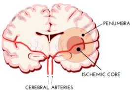 It is a medical emergency wherein the cells of the brain start dying within minutes of being deprived of nutrients and oxygen due to the restriction of blood supply. Stroke Dana Foundation