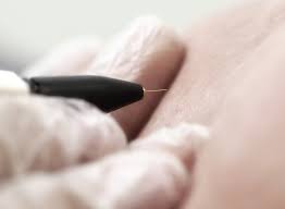 Like laser hair removal, electrolysis also takes multiple treatments to destroy the root of the hair. Electrolysis Hair Removal The Ultimate Guide Hair Removal Devices