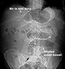 Image result for Adynamic Ileus