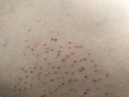 At your initial free, confidential consultation, a thorough health history will be conducted to fully understand any issues that could be related to excessive hair growth. Hair Removal Got Electrolysis Done 2 Days Ago On Bikini Area Is This Normal Skincareaddiction