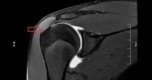 Maybe you would like to learn more about one of these? You Are Not Your Shoulder Ultrasound Breaking Muscle